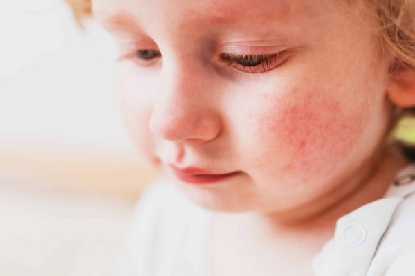 Les meilleurs traitements pour un eczéma du nourrisson